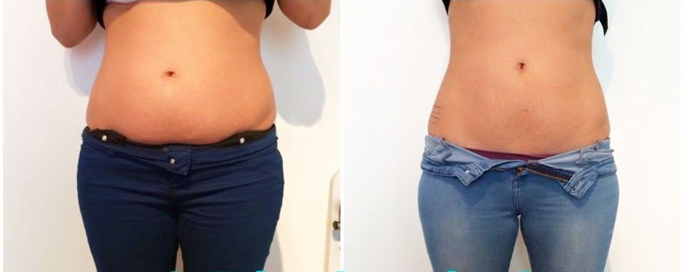 cavitation before and after1