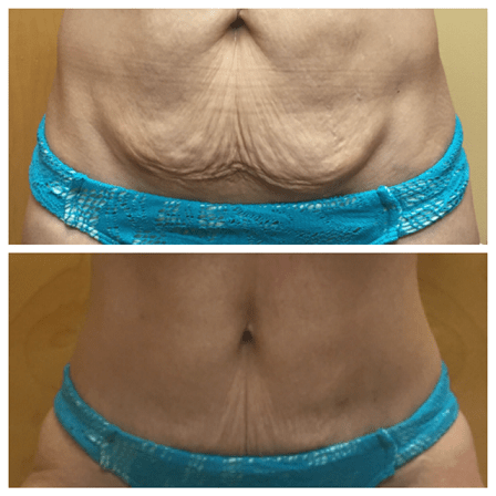 cavitation before and after5
